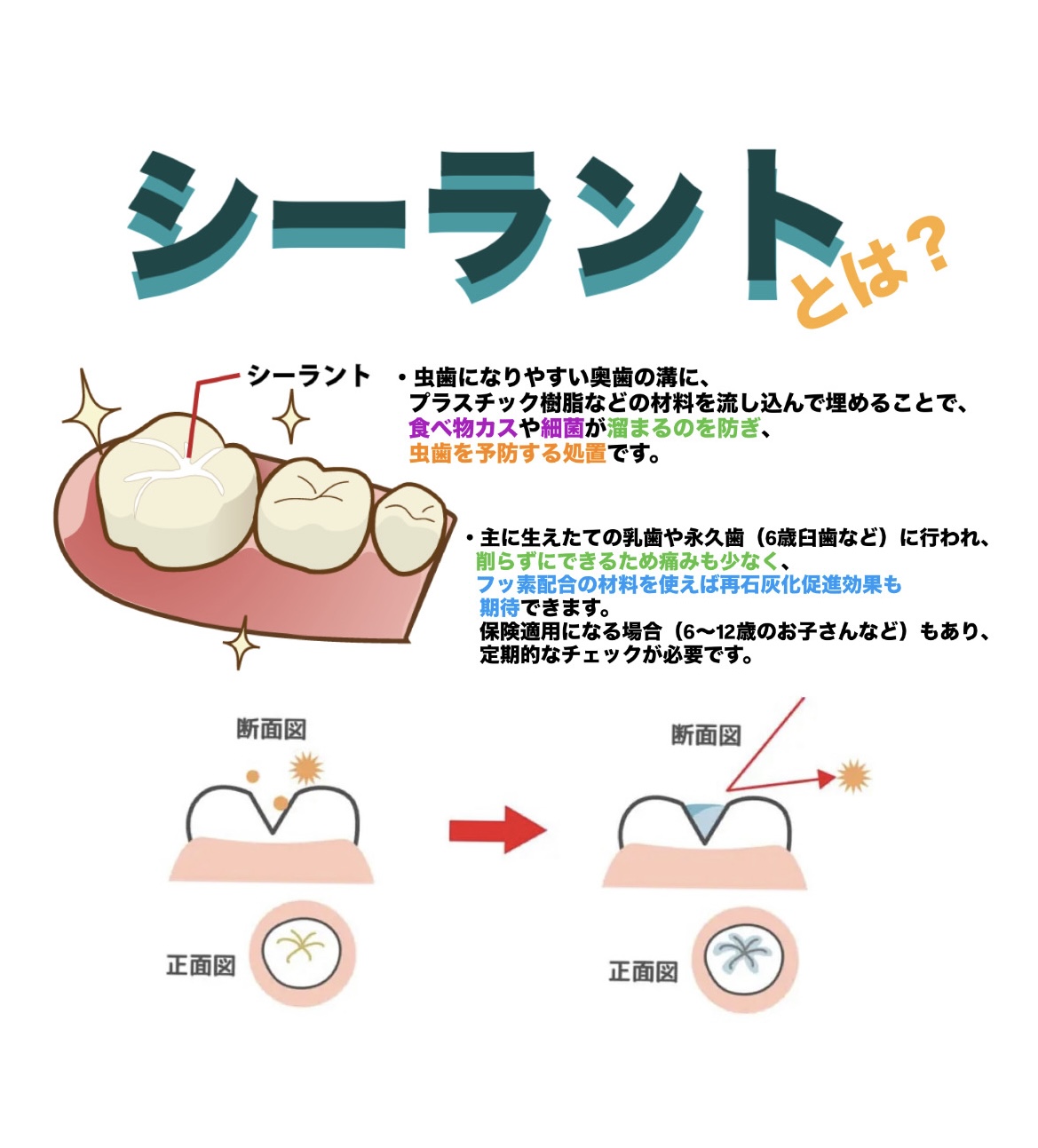 シーラントについて