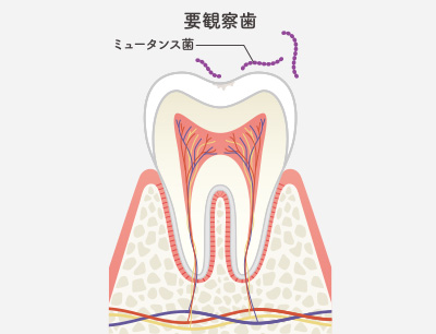 CO（初期の虫歯）