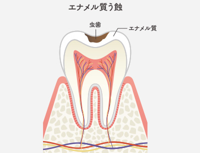C1（エナメル質の虫歯）