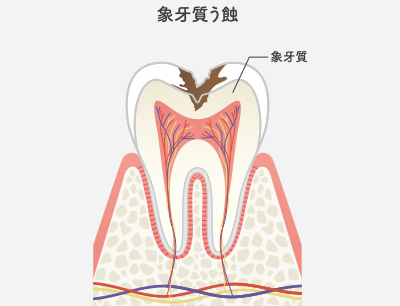 C2（象牙質の虫歯）