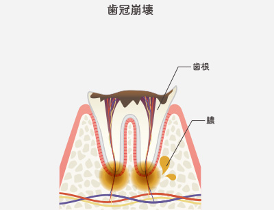 C4（歯の根っこだけが残っている虫歯）