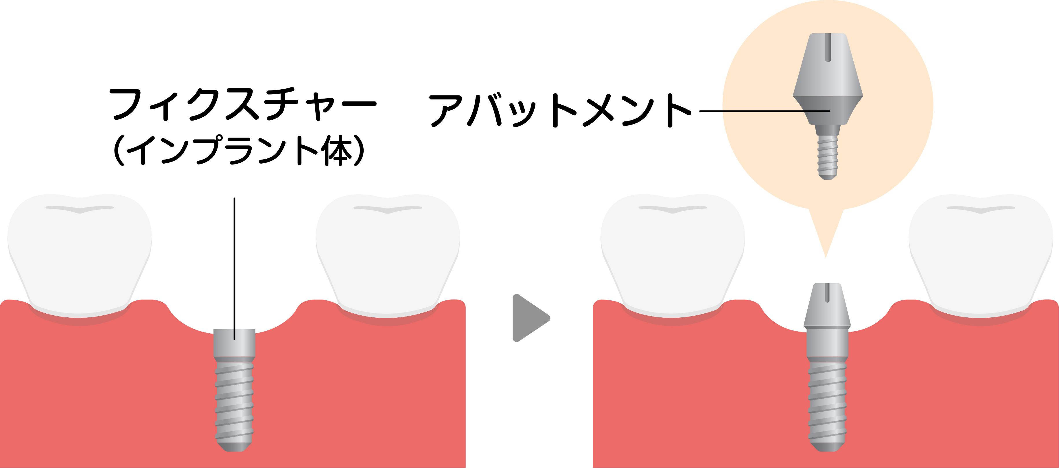 インプラント手術
