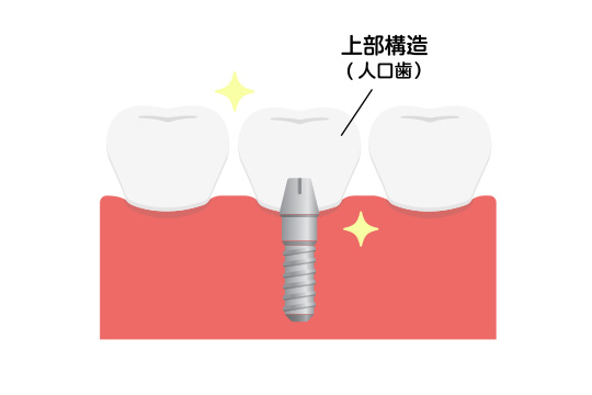 人工歯の作成・装着