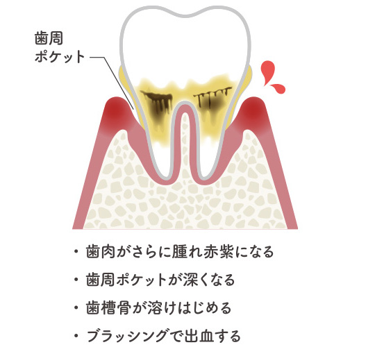 軽度歯周病