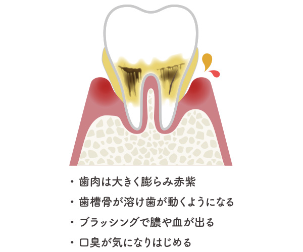 中度歯周病