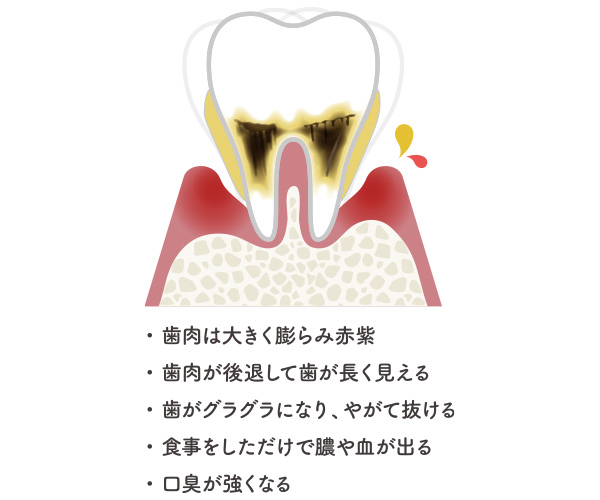 重度歯周病
