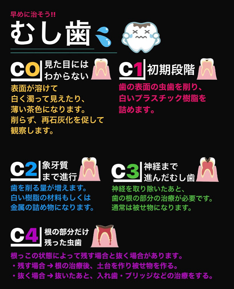 虫歯の進行度があるのをご存知ですか？