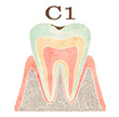 虫歯の進行段階ごとの治療法について