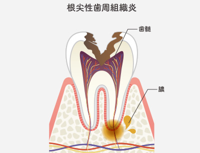 C3（歯髄にまで達した虫歯）