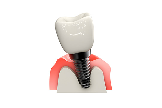 1本からすべての歯までインプラント対応可能